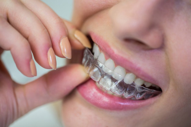 Diş Teli Çıktıktan Sonra Takılan Şeffaf Plak
