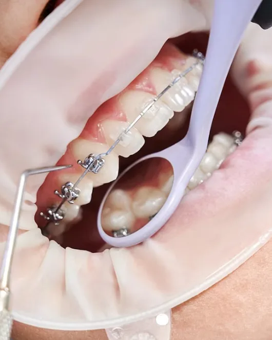 Ortodonti Çene Tedavisi
