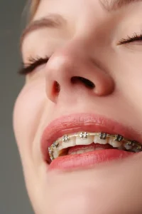 Sadece Üst Diş Teli