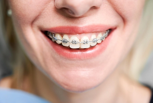 Ankara Ortodontist Tavsiye