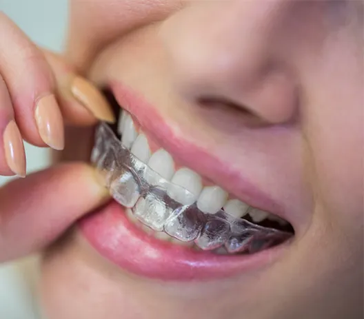 Diş Teli Takıldıktan Sonra Dişler Ne Zaman Düzelmeye Başlar?