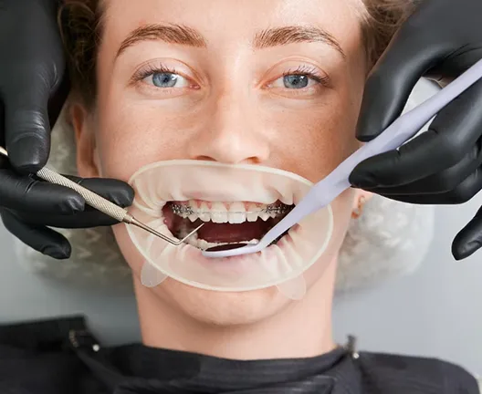 Diş Teli Takıldıktan Sonra Dişler Ne Zaman Düzelmeye Başlar?