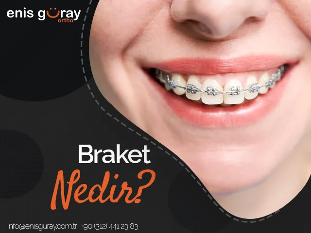 Braket Nedir?