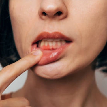 Periodontitis Nedir?