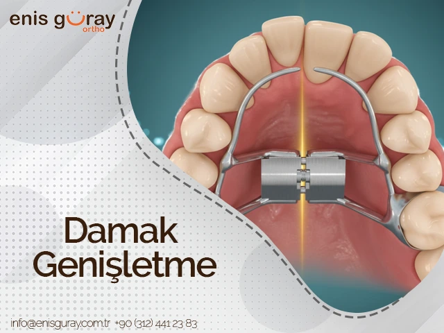 Damak Genişletme