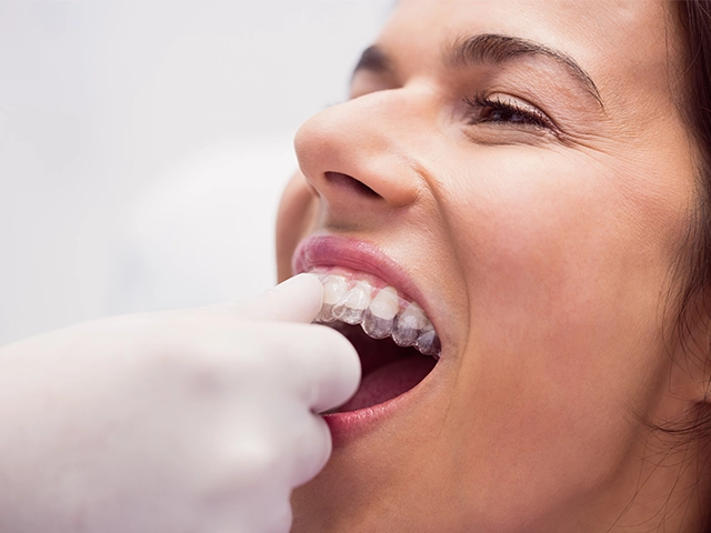 Invisalign Fiyatlari