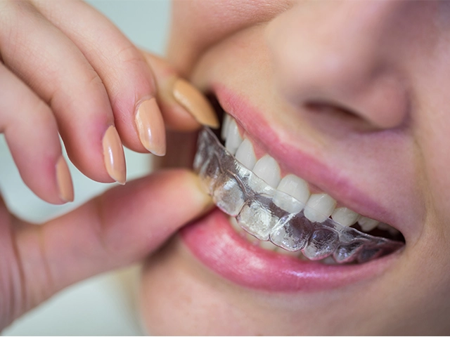 Invisalign Fiyatlari